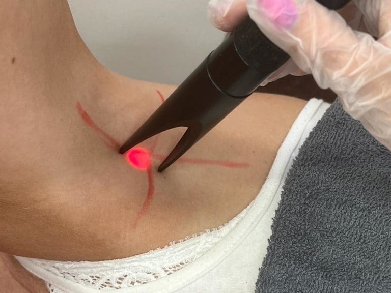 Hair removal Skin Treatment Lasers