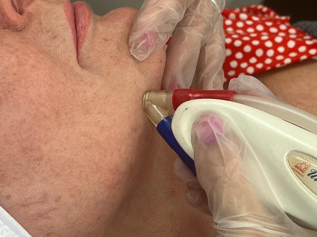 Using a Skin treatment laser machine