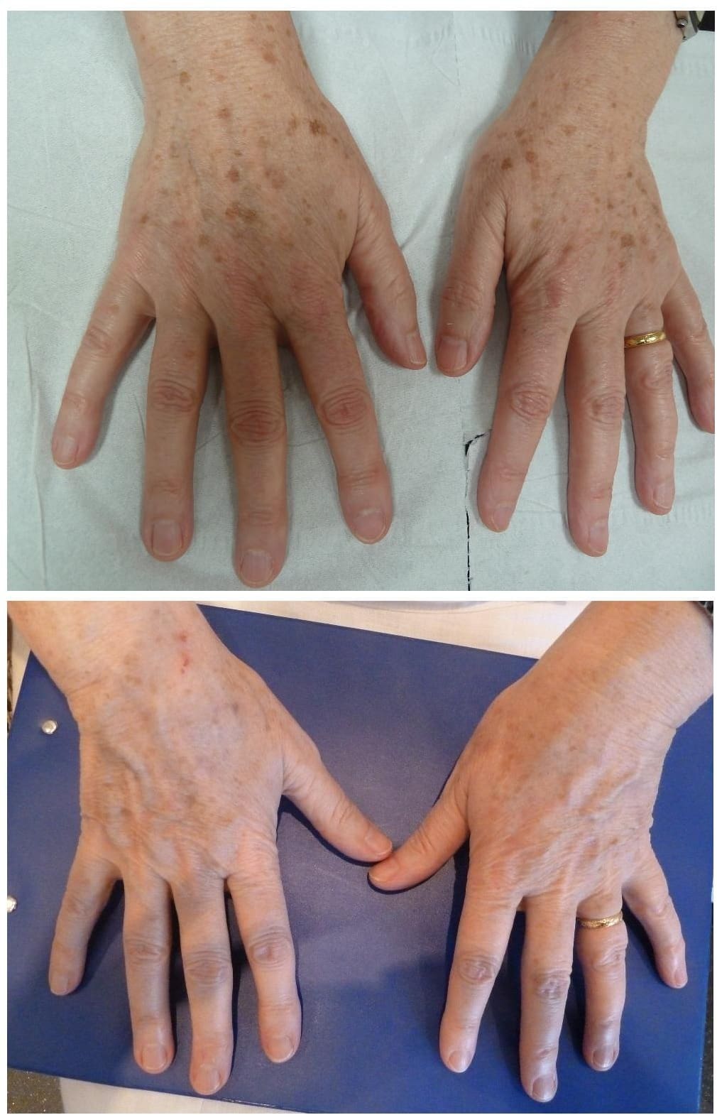 Before and after image of age spot removal after using the polaris 694 Ruby laser