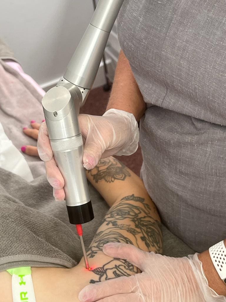 Accurately removing a tattoo using The Polaris RUBY 694 Q-Switched Laser articulated arm and laser light directional tool