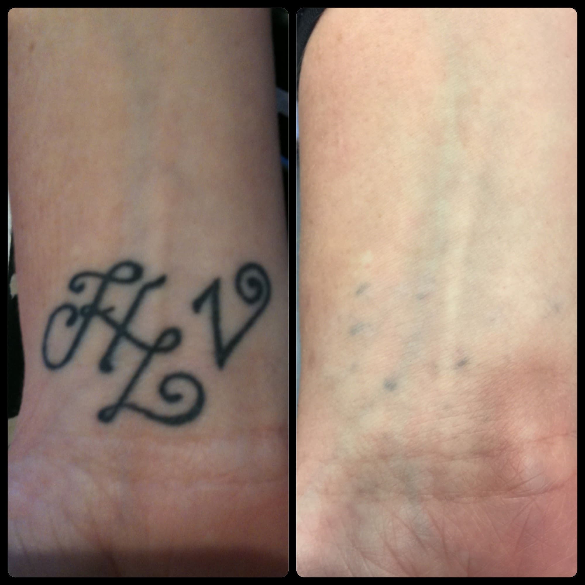 before and after image of an Arm Tattoo after treatment using The Polaris RUBY 694 Q-Switched Laser